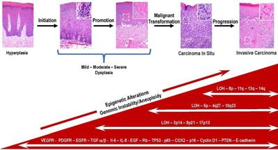Crosstalk between cancer stem cells and the tumor microenvironment drives progression of premalignant oral epithelium